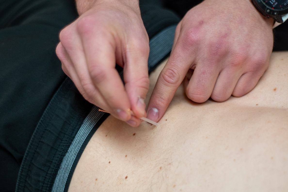Physio dry needling course